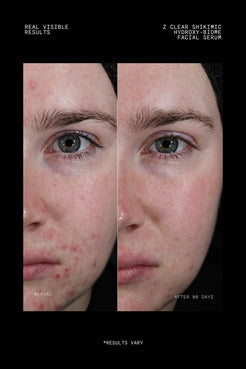 Before and after 90 days using Z Clear Shikimic Hydroxy-Biome Facial Serum showing reduced breakouts
