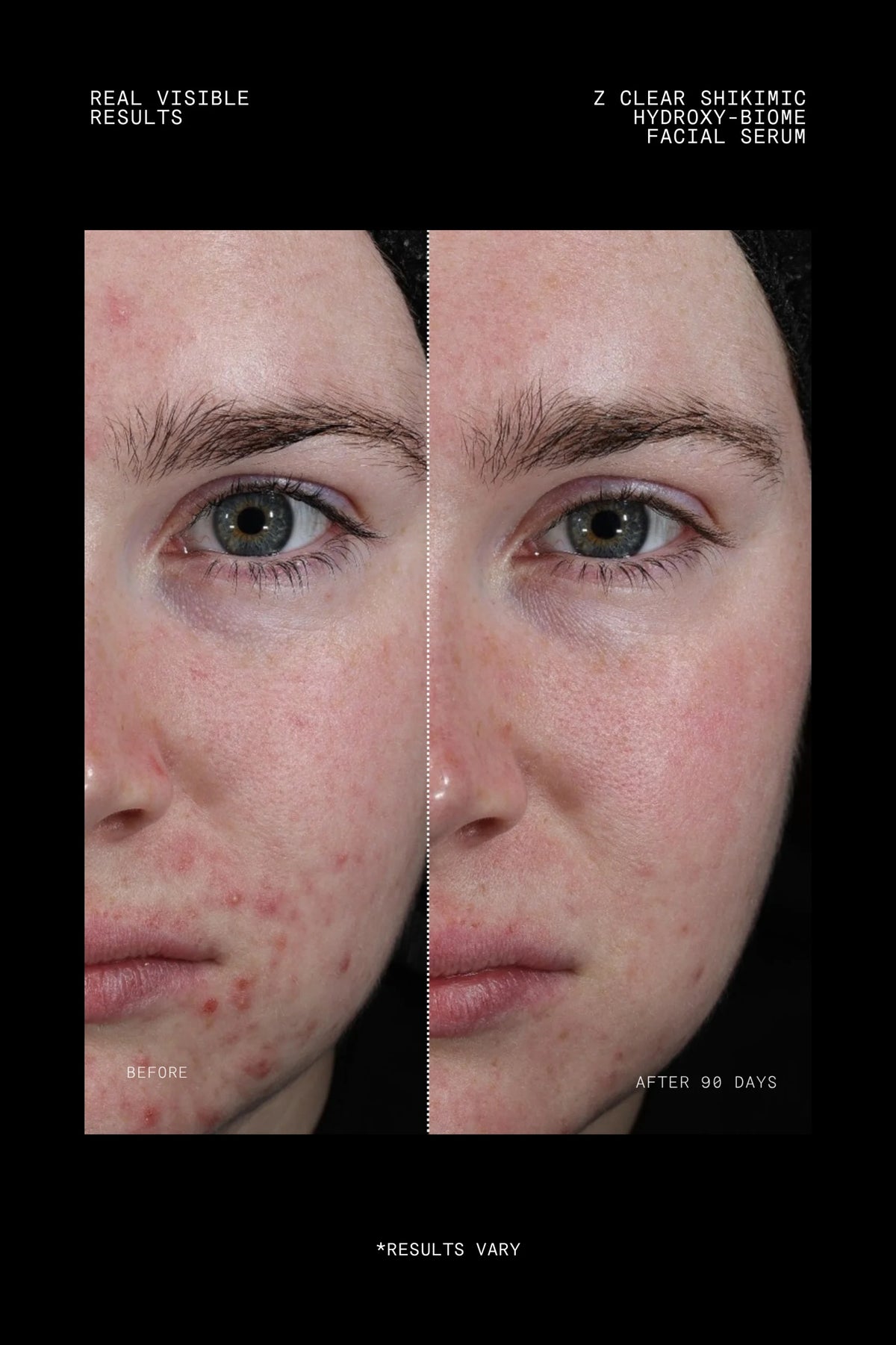 Before and after 90 days using Z Clear Shikimic Hydroxy-Biome Facial Serum showing reduced breakouts