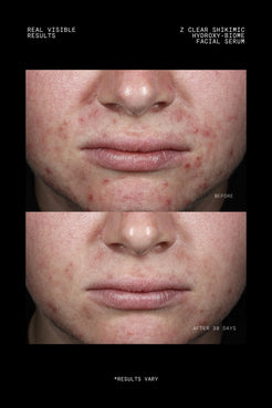 Before and after 30 days using Z Clear Shikimic Hydroxy-Biome Facial Serum on acne-prone skin around the mouth and chin