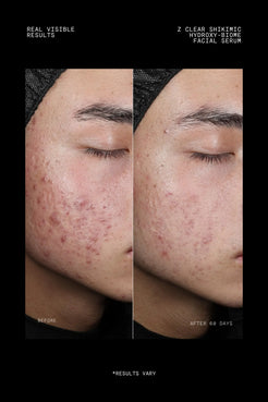 Before and after 60 days using Z Clear Shikimic Hydroxy-Biome Facial Serum on congested cheek skin