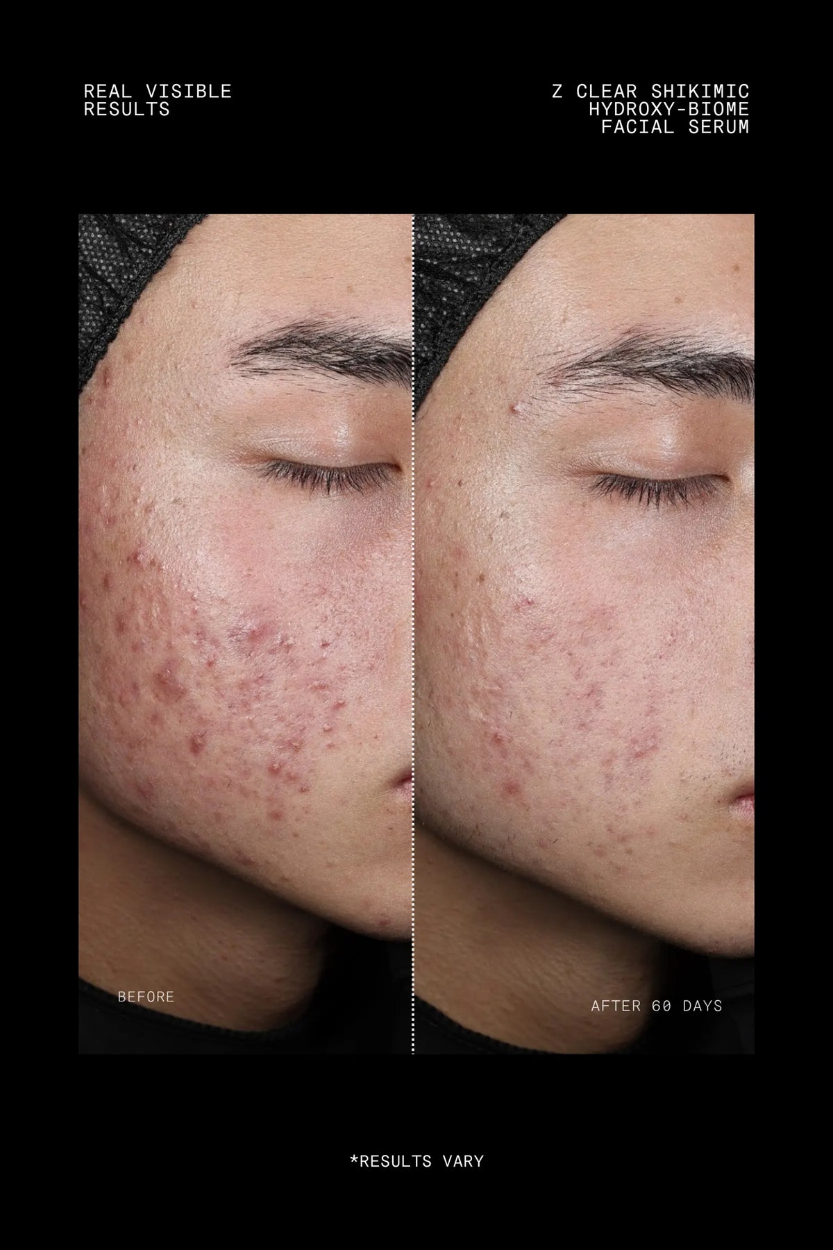 Before and after 60 days using Z Clear Shikimic Hydroxy-Biome Facial Serum on congested cheek skin